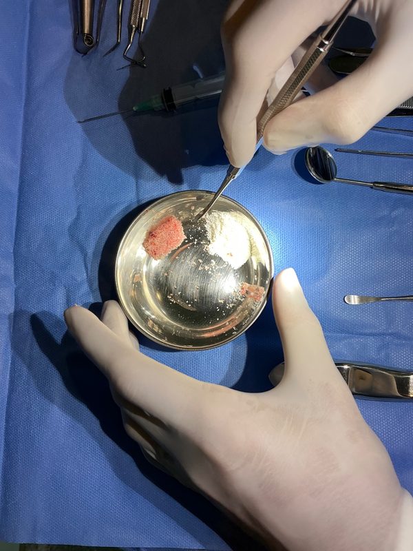 Equipo medico realizando un procedimiento odontologico con tejido oseo donado en el hospital